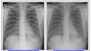 Radiographic Density and Contrast Part 1 – Hung's Little Corner